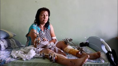Лікарі рятують від ампутації: у Львові лікується жінка з Бахмута