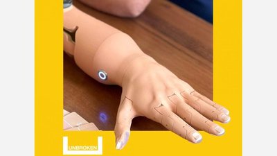 У Львові українцю встановили найлегший у світі протез, надрукований на 3D-принтері (ВІДЕО)