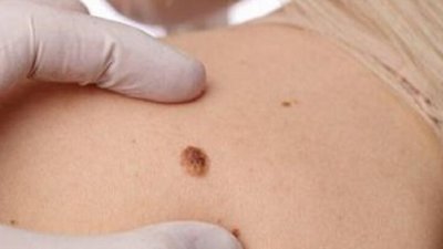 За вісім місяців в Україні на кір захворіло учетверо більше людей, ніж за весь минулий рік
