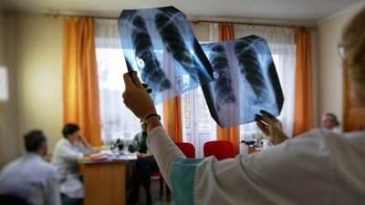 На Львівщині медики попереджають про можливий спалах туберкульозу