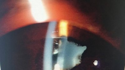 У Львові через котячу подряпину двоє дітей втратили зір