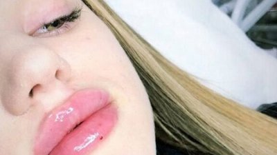 Популярна блогерка з Івано-Франківська Юлія Верба збільшила губи (ВІДЕО)
