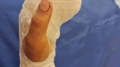 У Львівській області двоє підлітків травмувалися під час садіння картоплі (ФОТО)