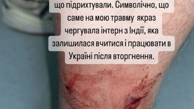 Міністра ЗС Кулебу покусала собака, коли той прогулювався у Києві