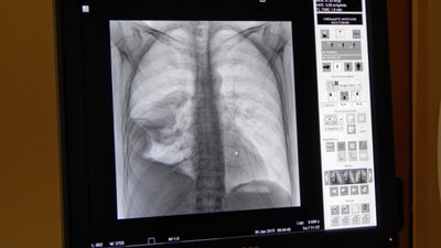 У МОЗ попередили про ризик одночасно захворіти на COVID-19 та грип