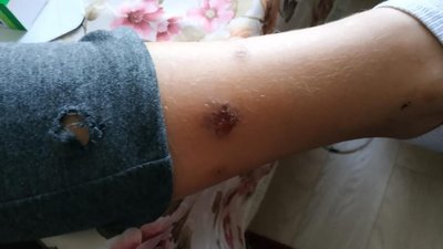 На Левандівці собака на зупинці громадського транспорту покусала хлопчика, який йшов до школи (ФОТО)
