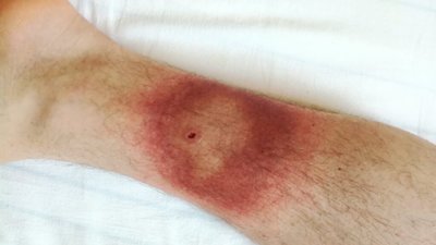 У Львові попереджають про небезпечне захворювання