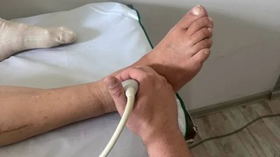 На Львівщині чоловіку врятували ногу