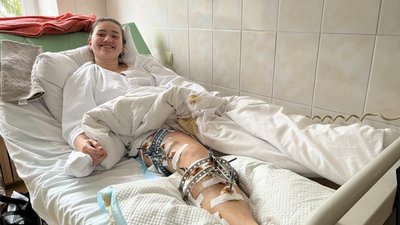 Одна нога коротша за іншу: у Львові лікарі прооперували 18-річну дівчину