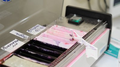 Львівський онкоцентр - єдиний заклад в області, де працює підрозділ термінової гістології в операційному блоці