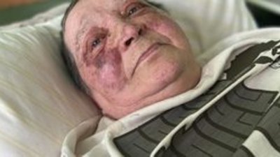 Львівські лікарі провели складну операцію журналістці та волонтерці з Херсона