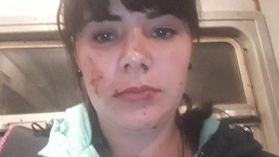 Пасажирка львівської електрички втратила зуби і зазнала травм обличчя