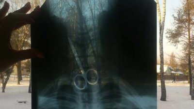 На Львівщині хірурги витягли з чоловіка ножиці