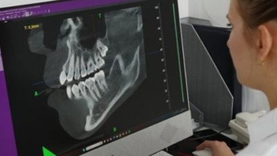 Коли потрібна КТ-діагностика перед імплантацією чи протезуванням