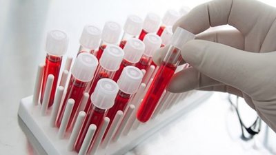 МОЗ: В Україні - спалах гепатиту А, епідемії немає
