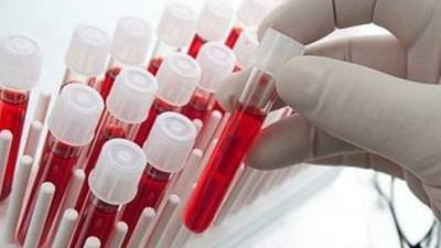 У Миколаєві вже 62 людей захворіли на гепатит А. Джерело досі не встановлене