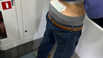 На кордоні з Польщею 59-річний француз прикріпив пластиром на тіло наркотичне «зілля»